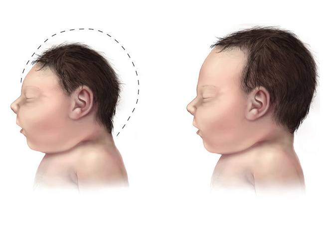 microcephaly stunting